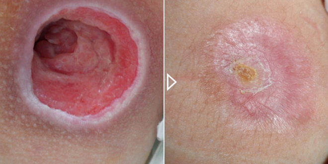 Aceleración de la cicatrización de heridas agudas y crónicas